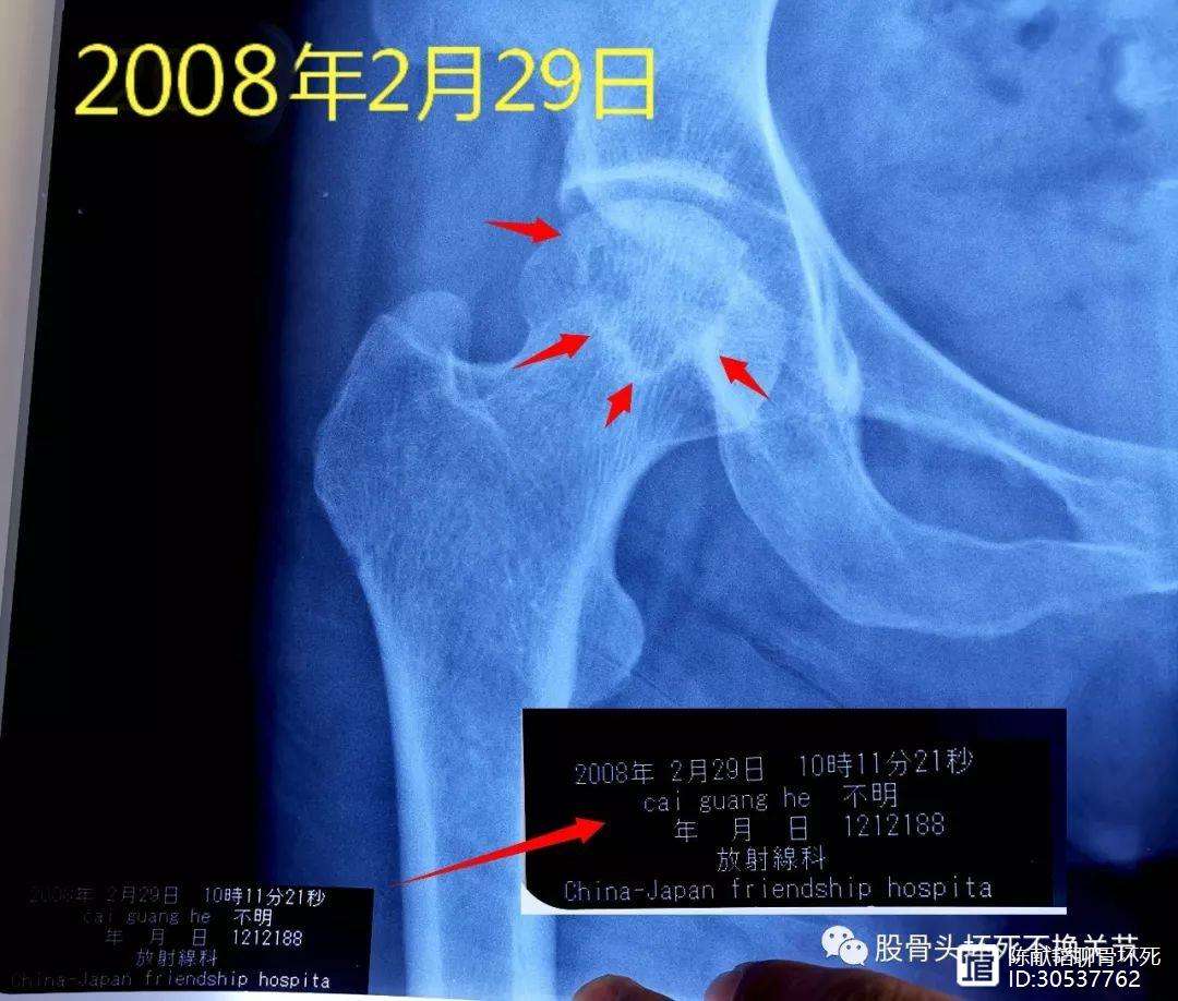 武汉人工骨头医保报销多少(人工骨头医保报销多少比例)
